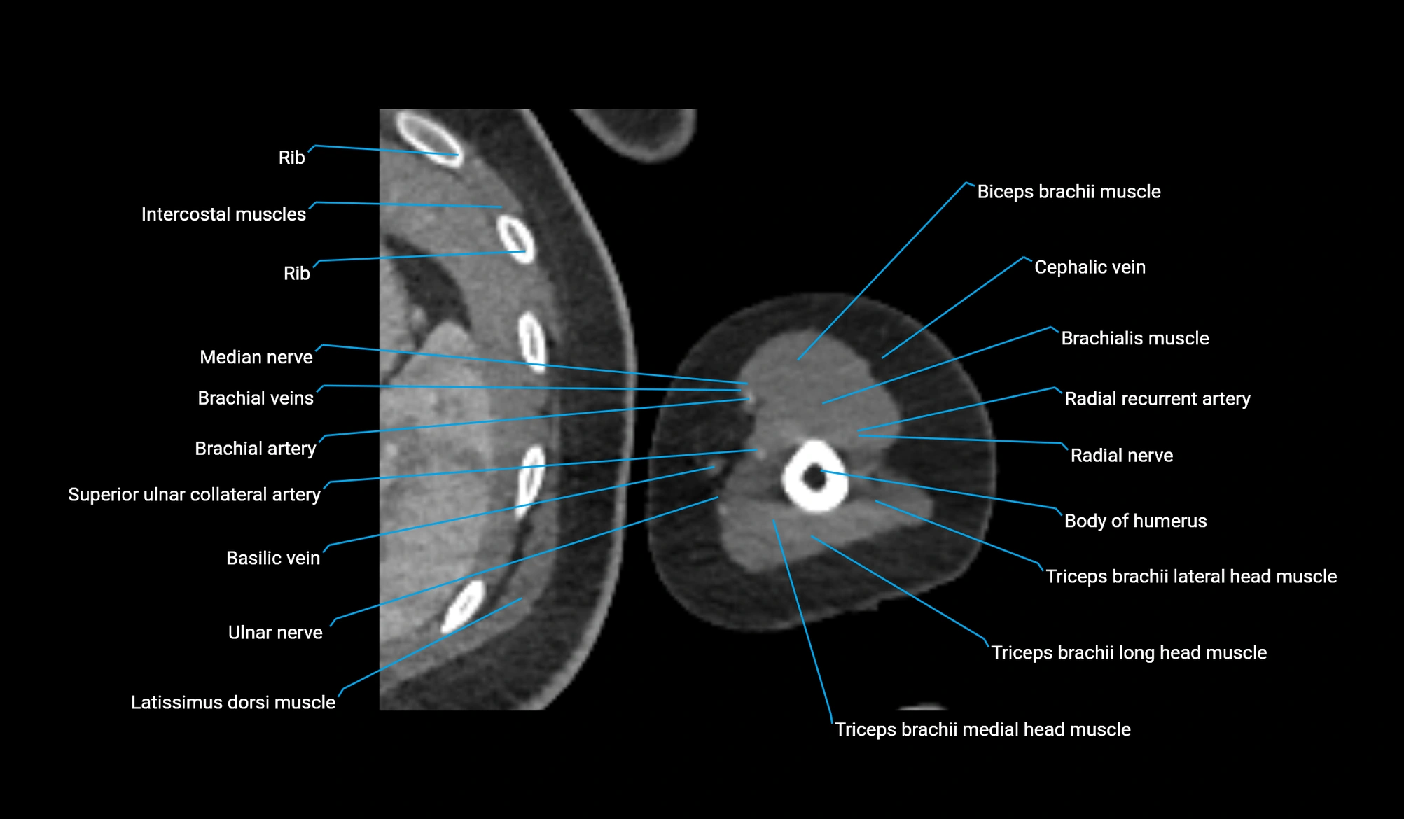 CT upper arm axial  cross sectional anatomy labelled radiology image -00300.webp